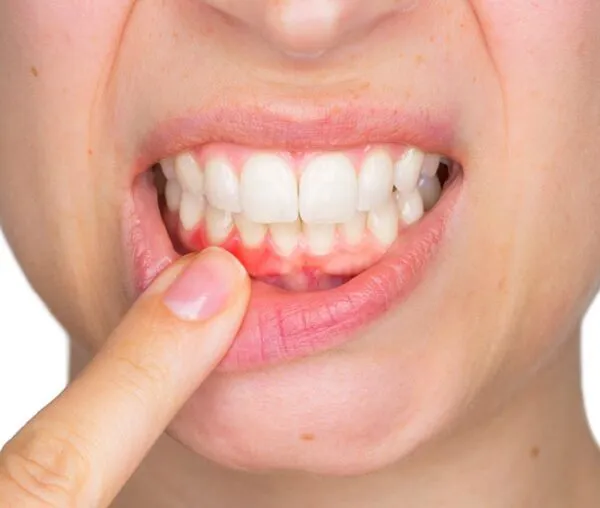 Periodontal Peptide Support – Gum Health Bioregulator